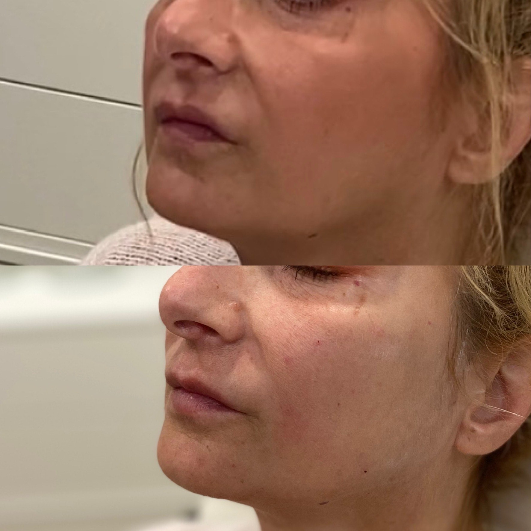 Collective Beauty Dermal Before