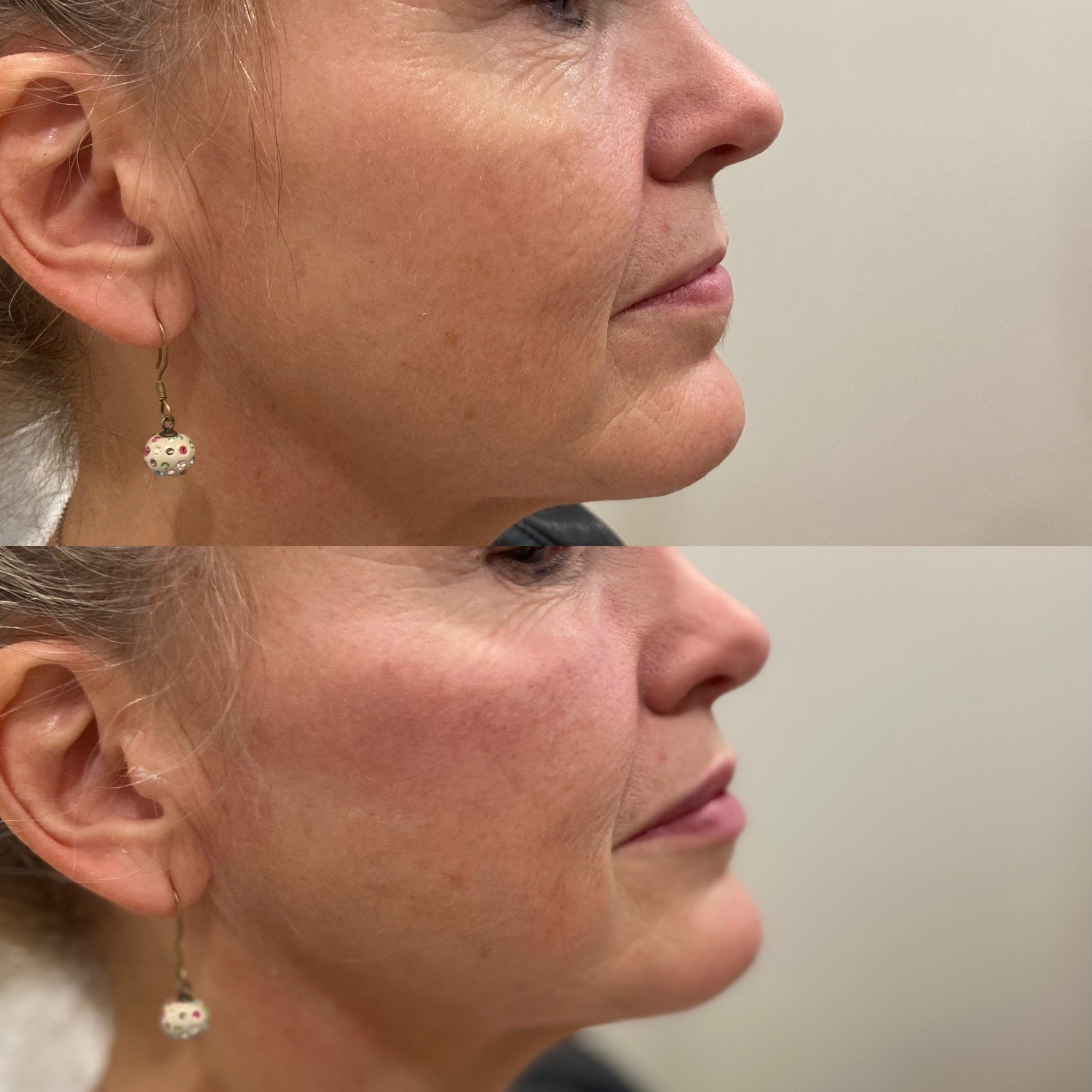Collective Beauty Dermal Before and After
