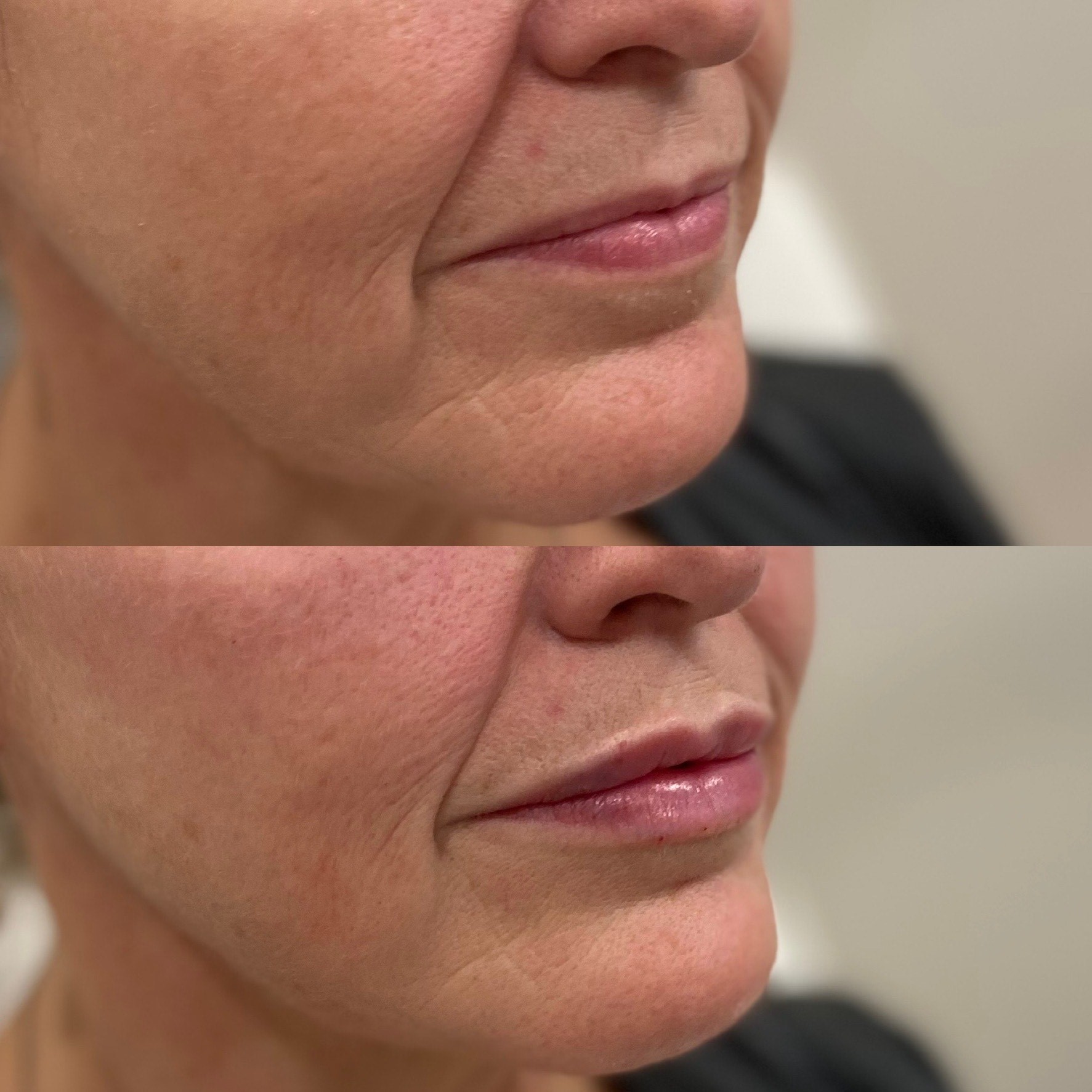 Collective Beauty Dermal Before and After