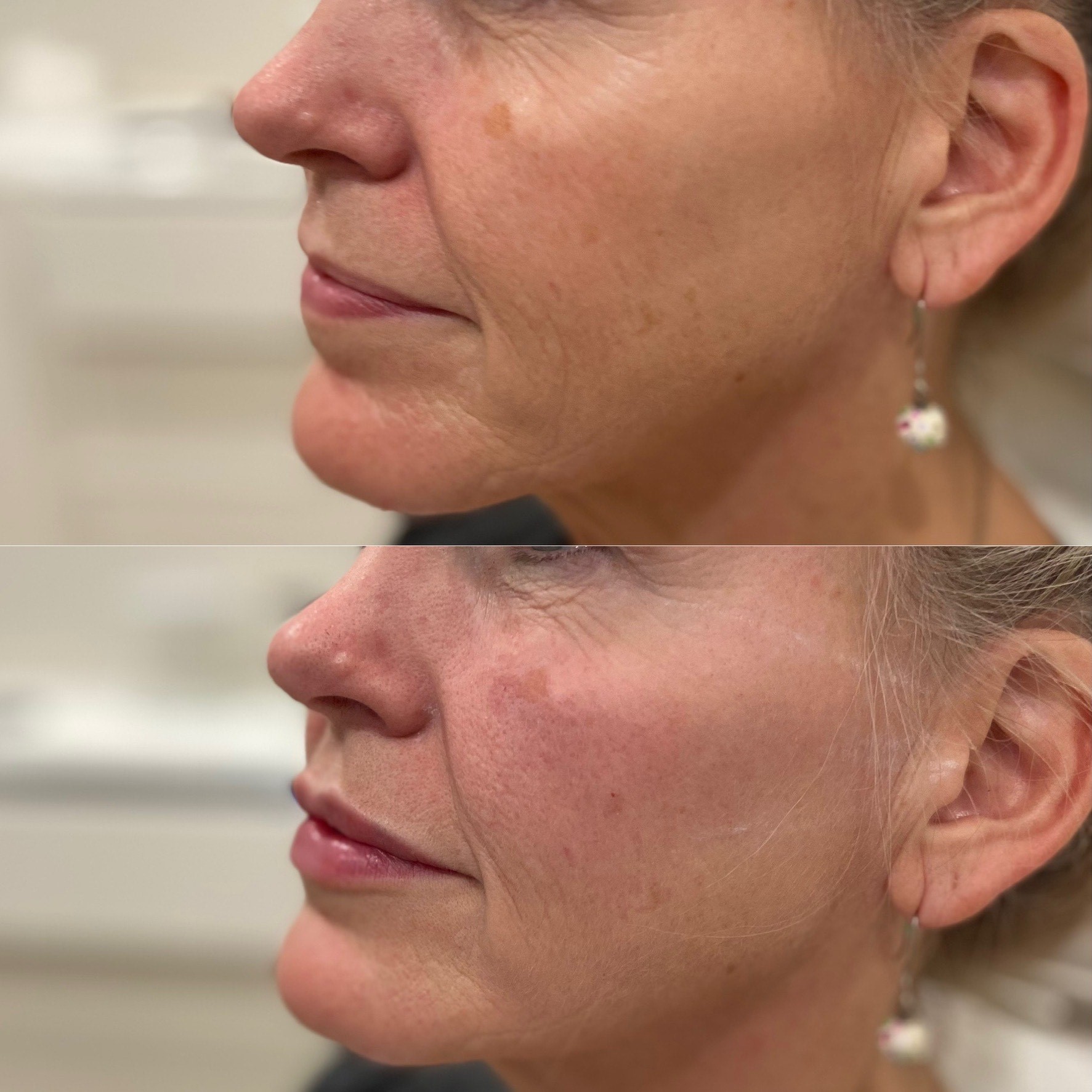 Collective Beauty Dermal Before and After