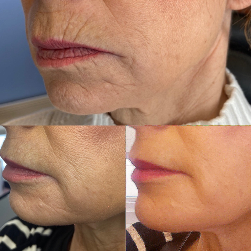 Collective Beauty Dermal Before and After