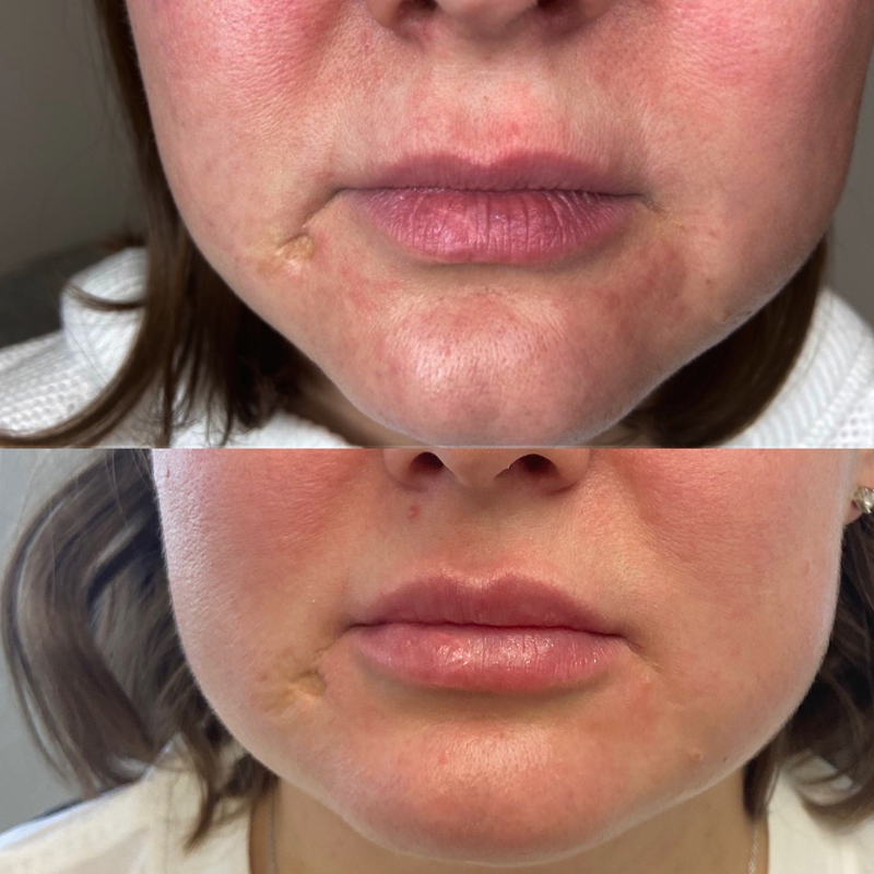Collective Beauty Dermal Before and After