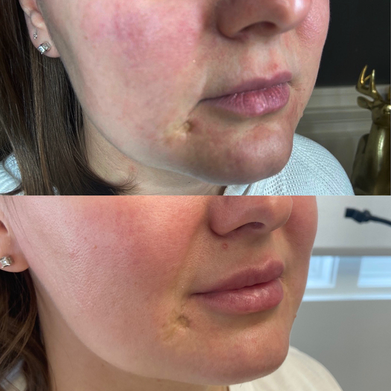 Collective Beauty Dermal Before and After