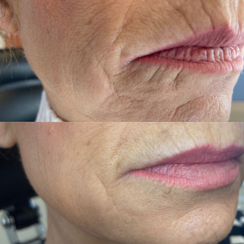 Collective Beauty Dermal Before and After