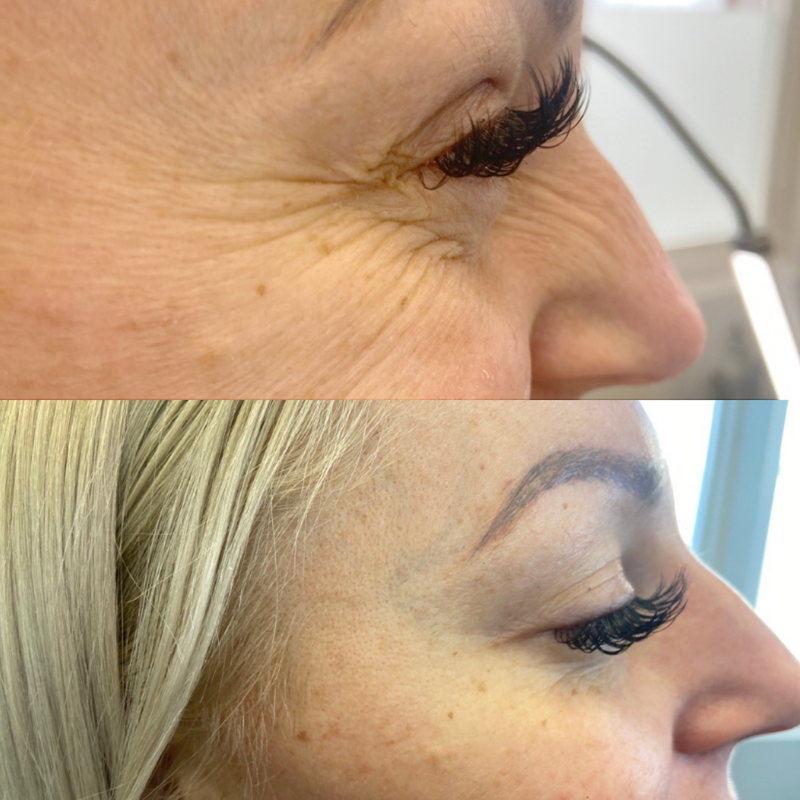 Collective Beauty Neuromodulator Before and After