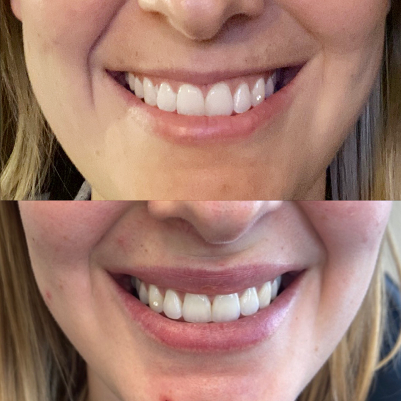 Collective Beauty Neuromodulator Before and After