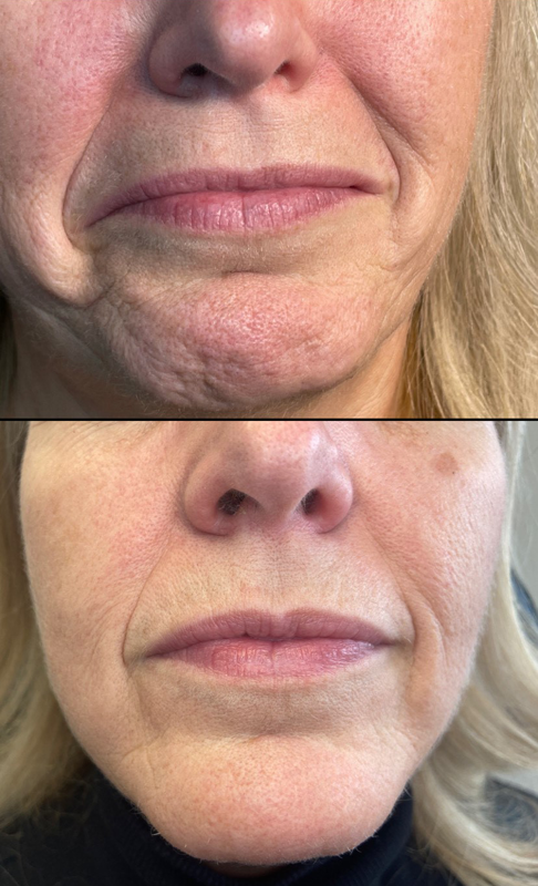 Collective Beauty Neuromodulator Before and After