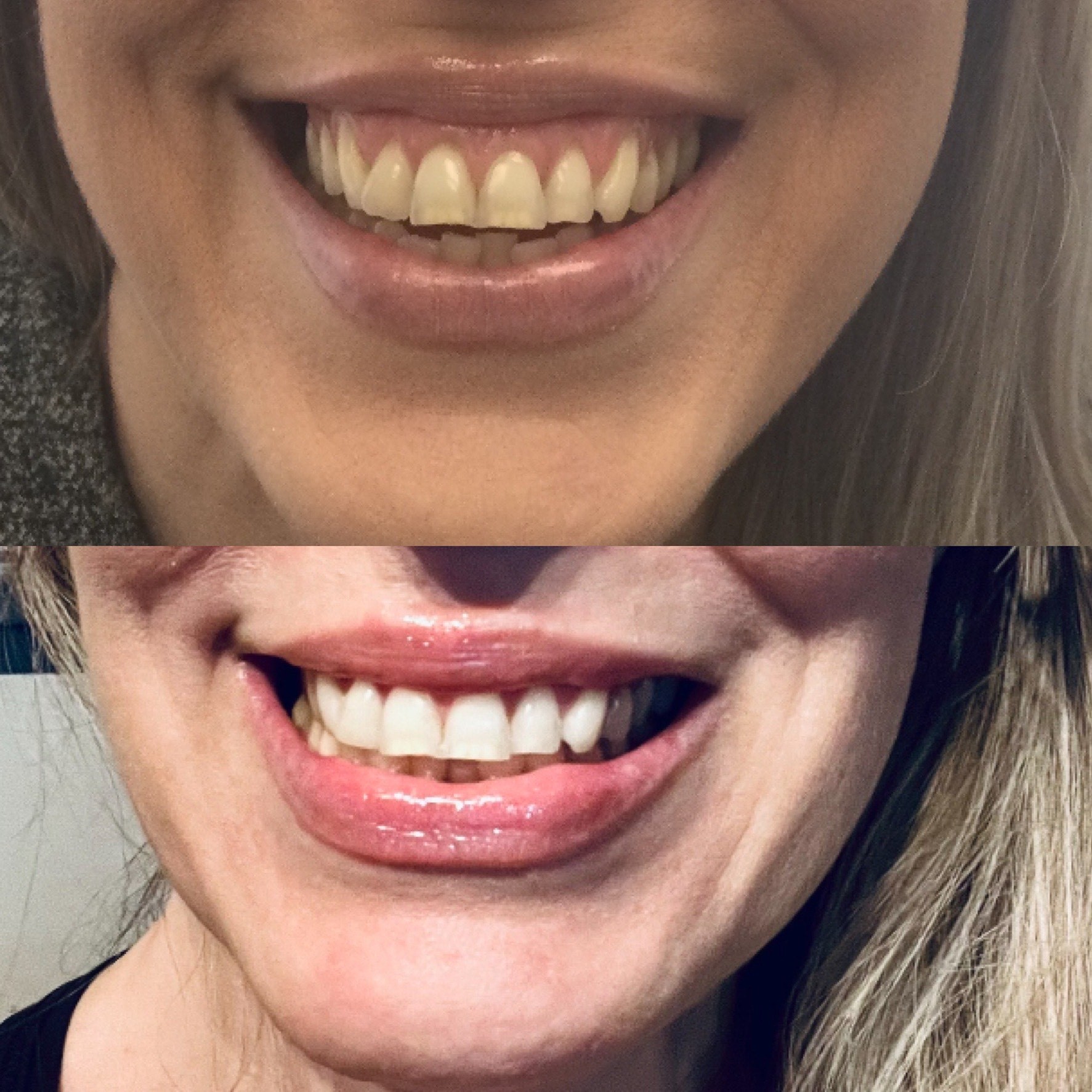 Collective Beauty Neuromodulator Before and After