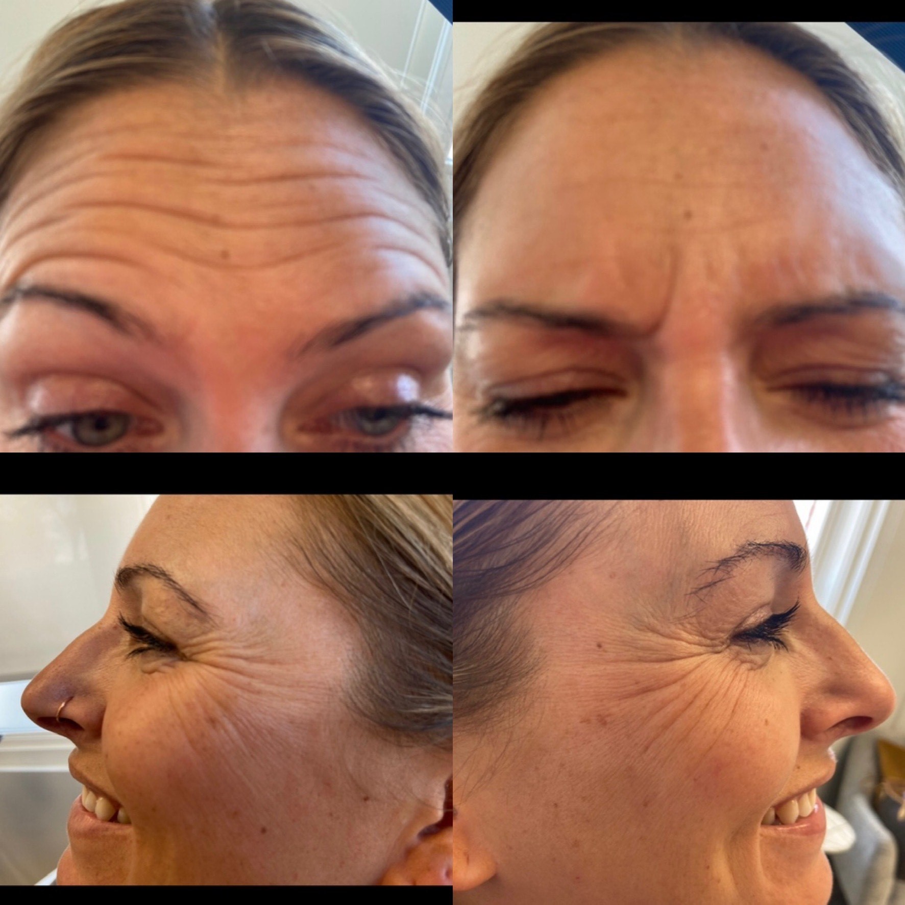 Collective Beauty Neuromodulator Before