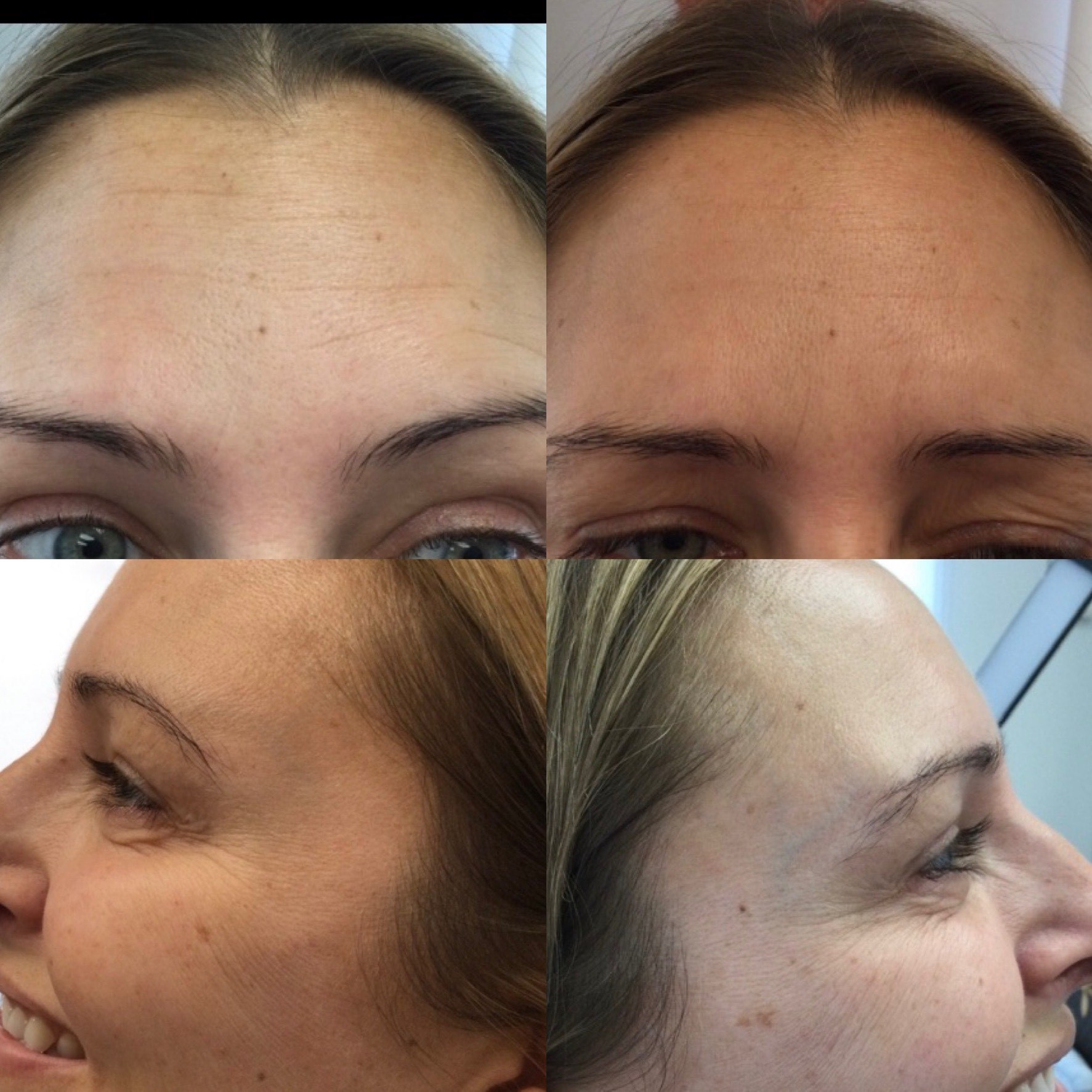 Collective Beauty Neuromodulator After